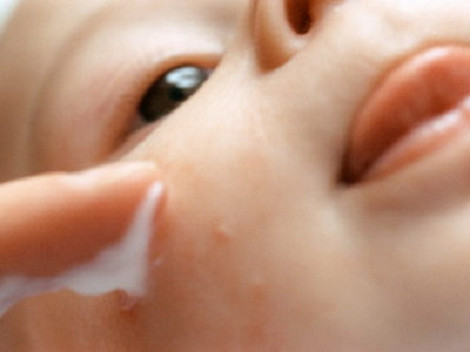 Với những bé sơ sinh, khi bị muỗi đốt, mẹ có thế vắt sữa mẹ bôi lên. Da bé sẽ không bị sưng và để lại vết sẹo thâm.