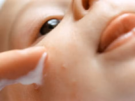 Với những bé sơ sinh, khi bị muỗi đốt, mẹ có thế vắt sữa mẹ bôi lên. Da bé sẽ không bị sưng và để lại vết sẹo thâm.