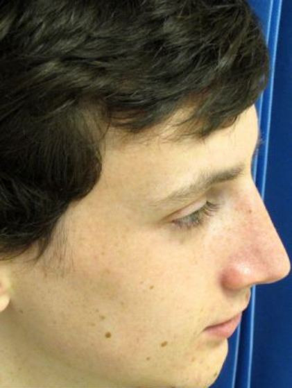 Với chiếc mũi thừa kế từ cha mẹ mình quá khổ và cao gồ ghề, Anh chàng này đã bỏ ra hơn 6.700 USD để thực hiện các ca phẫu thuật thu gọn mũi của mình.