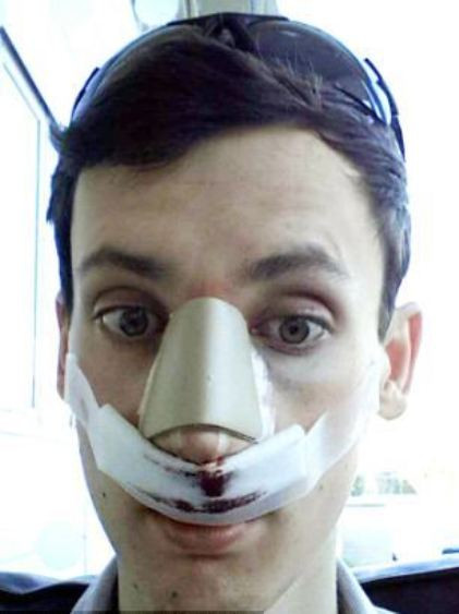 Sau khi sửa mũi, Cheshire chia sẻ hiện tại anh đã tự tin và sẵn sàng để thực hiện bất cứ điều gì, "tôi cảm thấy hạnh phúc và tự tin hơn", anh này nói thêm.