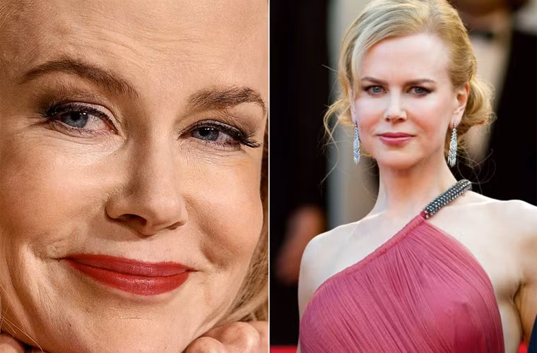 Đã vài lần viện tới Botox để kéo dài tuổi thanh xuân, nhưng những vết nhăn quanh mắt, miệng vẫn "ghé thăm" Nicole Kidman.