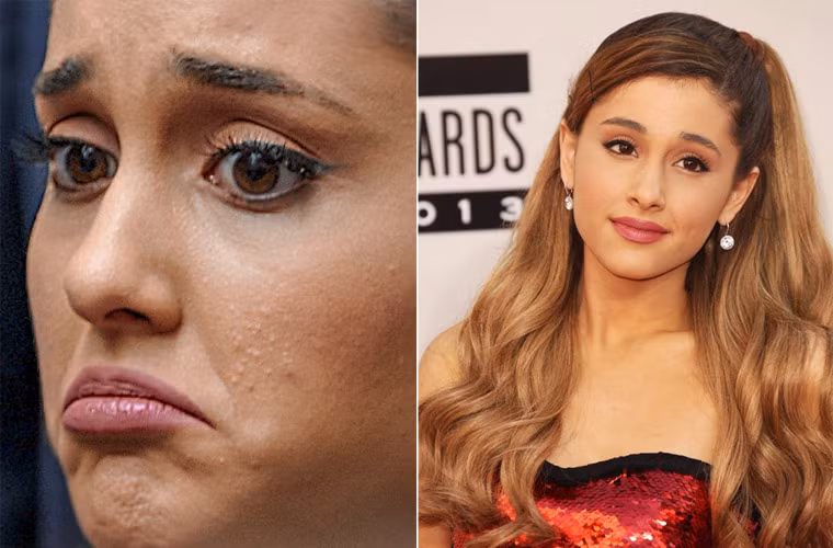 Khuôn mặt xinh đẹp của nữ ca sĩ kiêm diễn viên trẻ người Mỹ Ariana Grande bị mụn hoành hành.