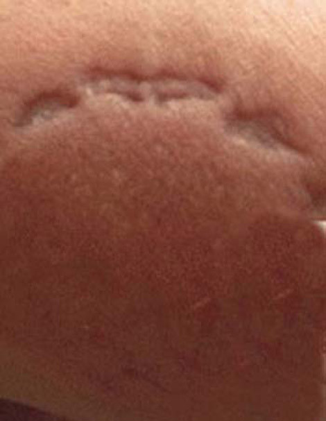 Vết răng trên tay chiến sĩ Nguyễn Mạnh Cường.