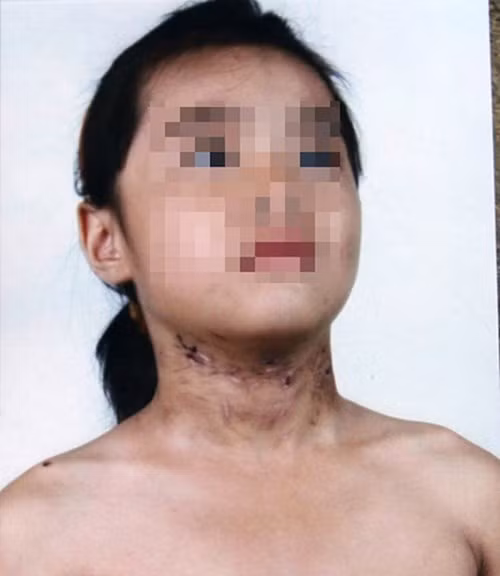 Cháu N.M.T (6 tuổi) bị cha đẻ, mẹ kế hành hạ như thời trung cổ.