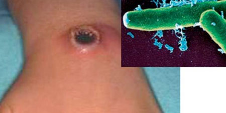 Đặc biệt, khi người trong gia đình có biểu hiện mắc bệnh than, phải kịp thời đến các cơ sở y tế gần nhất để được tư vấn, chăm sóc và điều trị.