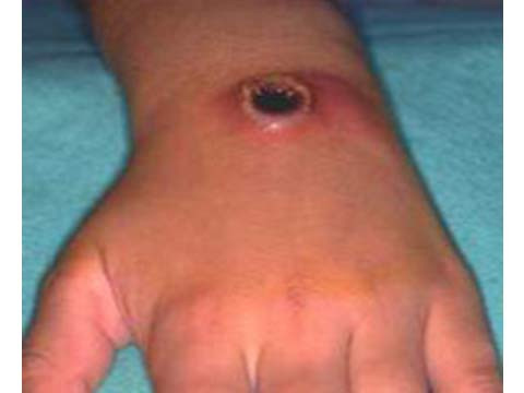 Tùy theo đường vào của vi khuẩn, bệnh được chia làm 3 thể: Bệnh Than ngoài da: Gây tổn thương da dạng mụn rồi vết loét, hầu như không đau. Đây là dạng nhẹ nhất, nhưng nếu không được điều trị, bệnh có thể lan rộng và gây nhiễm trùng huyết, dẫn tới tử vong trong 1/20 trường hợp.