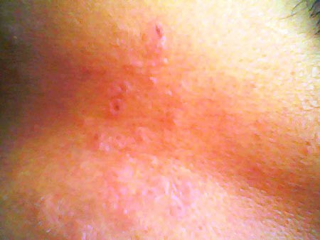 Sau đó từ 1 - 3 ngày, những mụn nước đó to thành phỏng nước, phỏng mủ. Lúc này, nhiều người bệnh ngoài biểu hiện tại chỗ còn có biểu hiện ngây ngấy sốt, khó chịu, nổi hạch, đau vùng cổ, nách, bẹn.