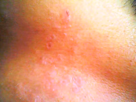 Sau đó từ 1 - 3 ngày, những mụn nước đó to thành phỏng nước, phỏng mủ. Lúc này, nhiều người bệnh ngoài biểu hiện tại chỗ còn có biểu hiện ngây ngấy sốt, khó chịu, nổi hạch, đau vùng cổ, nách, bẹn.