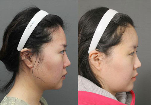 Rạch một đường nhỏ và tiêm mỡ vào trán thành nhiều lớp một cách đều đặn bắt đầu từ cách đường chân tóc khoảng 1cm đến vùng chân mày, gốc mũi. Khâu vết mổ và hoàn thành vầng trán.