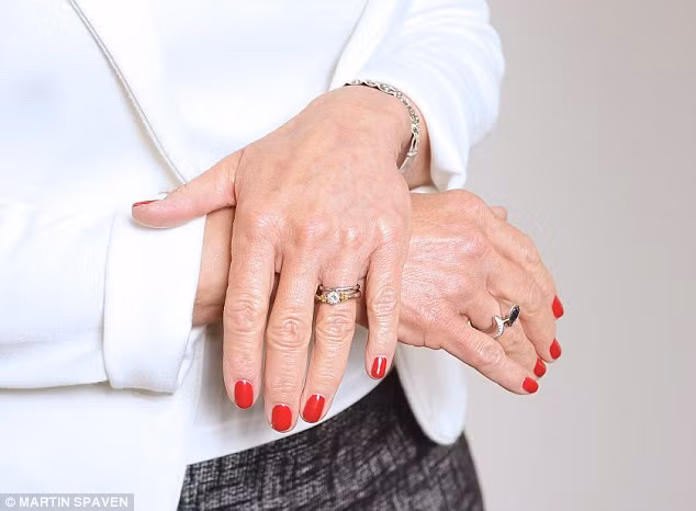 Mặc dù được cảnh báo có rất nhiều nguy cơ tiềm ẩn từ phương pháp thẩm mỹ này, nhưng ngày càng nhiều phụ nữ liều mình vì cái đẹp nhất thời. Hiệp hội phẫu thuật thẩm mỹ Anh cũng thống kê cho biết con số những người sử dụng thủ thuật này trong năm qua đã tăng 15%. Bà Rosetta Citton cũng tỏ ra rất vui mừng sau khi tiêm mỡ tự thân trẻ hóa da tay.