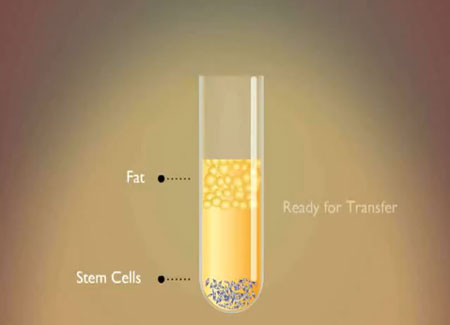 Các tế bào mỡ sau khi được tách mô khỏe mạnh và hư hỏng riêng biệt sẽ được tiêm bào mu bàn tay, ngực hay phần da mặt bị lão hóa.