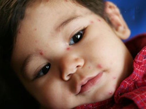 Dùng giấm trị thủy đậu. Bạn có thể đã nghe rằng nên dùng giấm nâu pha vào nước tắm sẽ giúp xoa dịu bệnh thuỷ đậu. Nhưng liệu việc dùng chất lỏng có tính axit để trị ngứa ngáy cho làn da nhạy cảm của bé có hợp lý không? Những bà mẹ có kinh nghiệm chắc chắn sẽ hiểu cách trị liệu này làm đau bé hơn là xoa dịu bé.