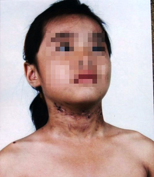 Ngoài vết thương trên cổ đã thành sẹo, cháu T còn bị gãy rẻ xương sườn số 6. Dư luận cho rằng chính mẹ kế và bố đẻ cháu T là người đã đánh cháu.