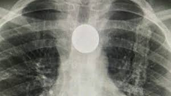 Cô bé suýt mất mạng vì bắt chước trò “ảo thuật” trên TikTok Co be suyt mat mang vi bat chuoc tro “ao thuat” tren TikTok