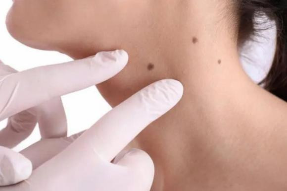 Not ruoi moc o 3 bo phan hay “lien quan mat thiet” den ung thu