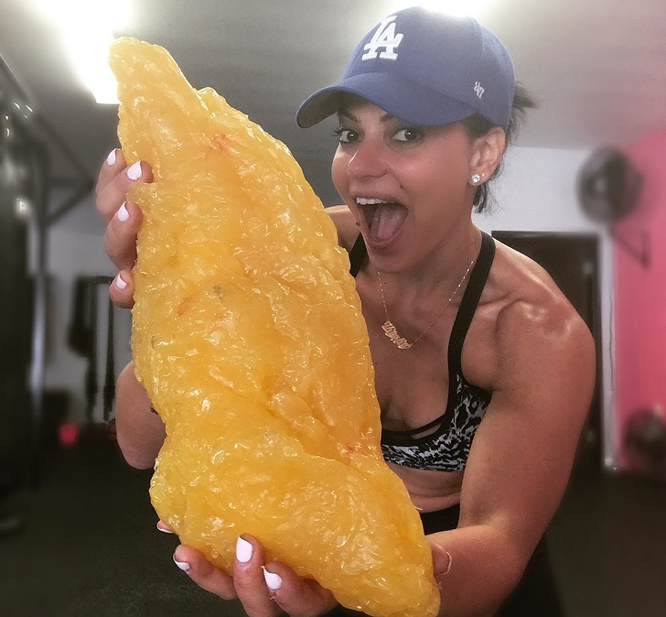 Đây là hình ảnh của khối chất béo nặng đến 2,27 kg.