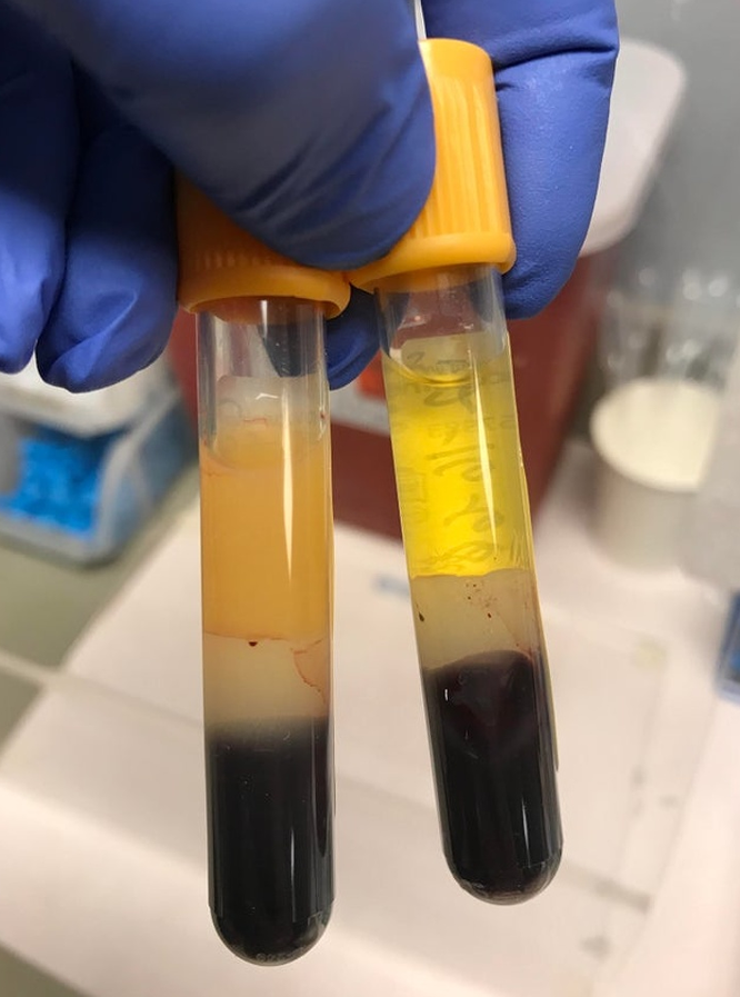 Sự ảnh hưởng của chế độ ăn đối với huyết thanh: huyết thanh của người ăn kiêng (bên phải) và không ăn kiêng (bên trái).