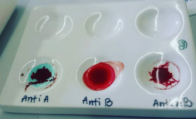 Để kiểm tra nhóm máu, các bác sĩ lấy mẫu máu trộn với các kháng thể khác nhau. Kết quả dựa trên độ kết dính của các tế bào hồng cầu trong máu.