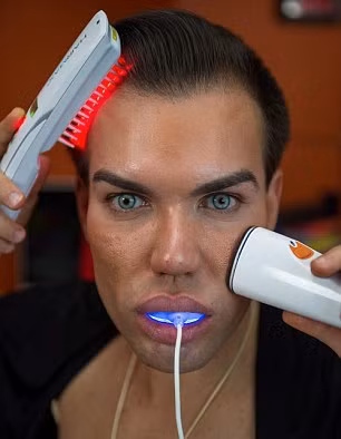 Gần đây, anh chàng búp bê sống này lại chi ra hơn 8.000 USD (gần 200 triệu đồng) để thực hiện thủ thuật cấy tế bào tóc nhân tạo chữa chứng hói đầu.