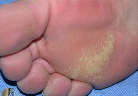 Một điều đặc biệt cần lưu ý là không nên dùng kìm cắt những lớp da sần vì rất dễ gây tổn thương, chảy máu. Việc cắt da có thể kích thích lớp da non tái tạo và bị chai cứng nhanh hơn.