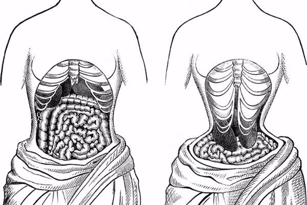  Vòng eo siêu nhỏ: Để có được vòng eo siêu nhỏ, người phụ nữ xưa kia phải sử dụng chiếc áo nịt định hình vóc dáng. Đỉnh cao của xu hướng vào thời gian Catherine de’ Medici, vợ của vua Henry II của Pháp sinh sống. Bà thậm chí đã ban hành lệnh cấm những người có vòng eo lớn xuất hiện. Được biết, những chiếc áo nịt có thể giảm vòng eo tới 35 cm, gây ảnh hưởng lớn tới các cơ quan nội tạng. 