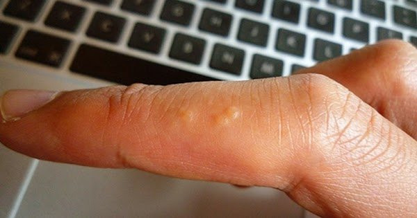 6 trieu chung tren ngon tay canh bao co benh trong nguoi-Hinh-3