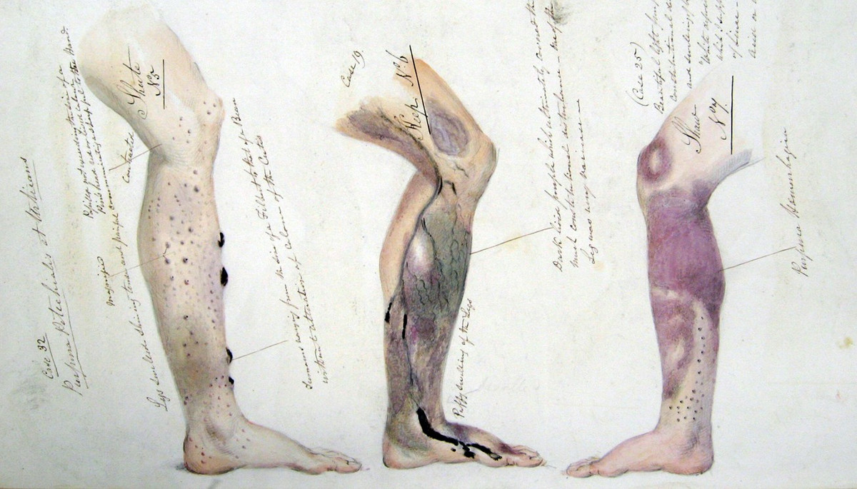 Các vết thâm tím, lở loét sẽ lan rộng trên da, thêm vào đó là nguy cơ dễ bị nhiễm trùng. Về mặt tâm thần, người mắc bệnh dễ bị kích động hoặc rơi vào trầm cảm, có trường hợp trở nên điên loạn.