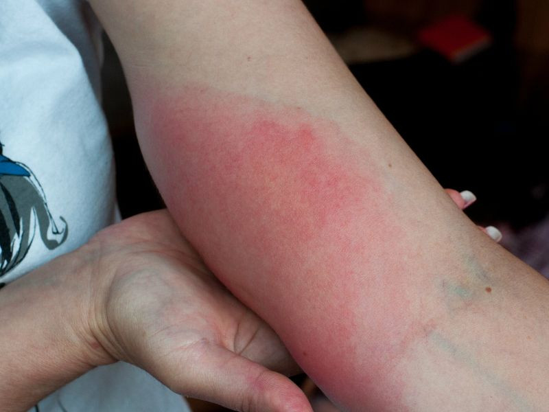 Bi ong dot hon 150 vet, nguoi dan ong nguy kich tinh mang