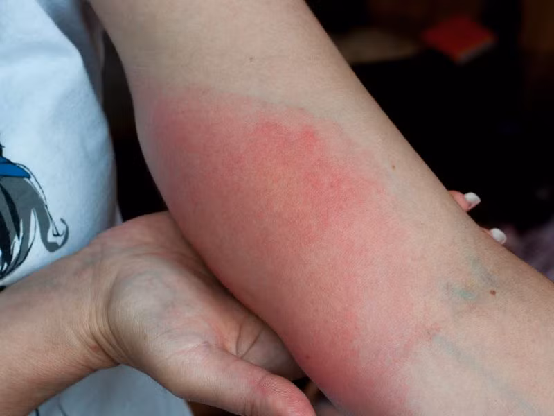 Bi ong dot hon 150 vet, nguoi dan ong nguy kich tinh mang