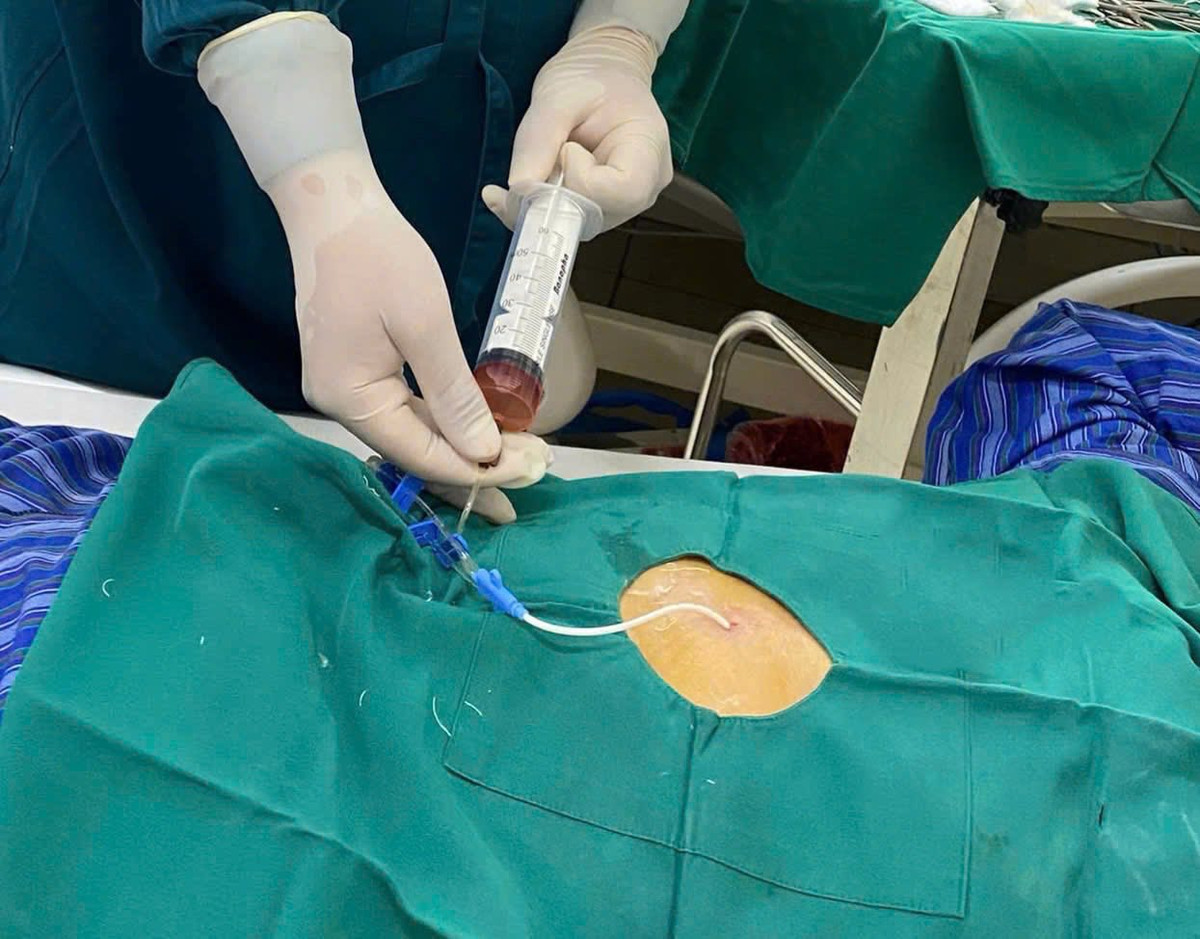 Cuu song cu ong bi tran dich mang ngoai tim do lao