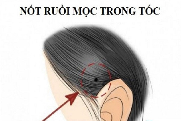  1. Nốt ruồi ở chân tóc. Vị trí đường chân tóc tượng trưng cho vận số, sự nghiệp hanh thông và trí tuệ của một người. 