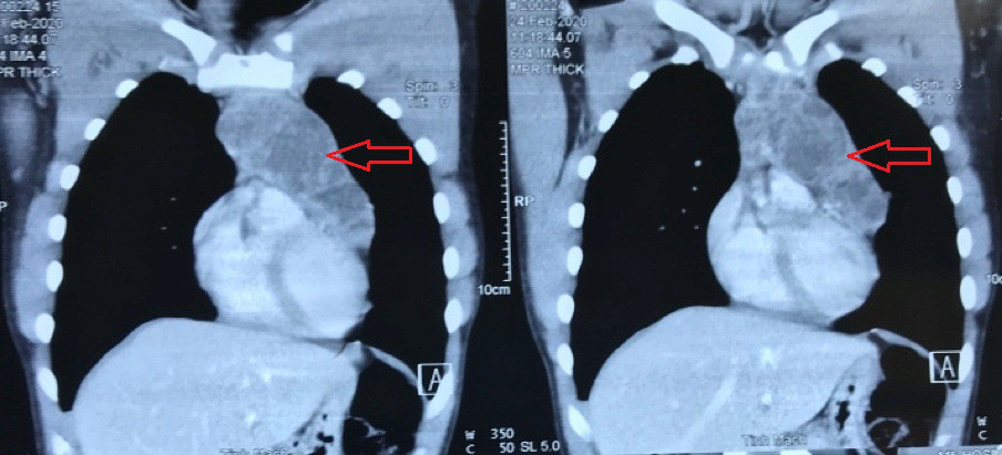 Ho nhói nhẹ, vào viện phát hiện khối u ngực chèn ép nguy hiểm Ho nhoi nhe, vao vien phat hien khoi u nguc chen ep nguy hiem