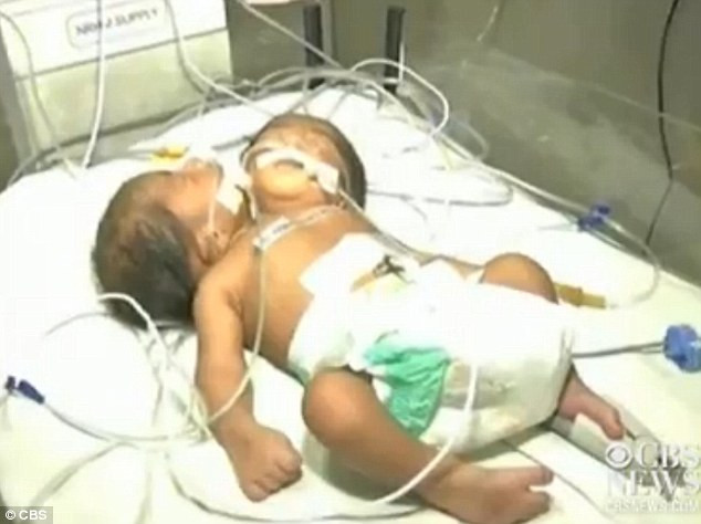 Cặp song sinh dính liên thân ở Ấn Độ.