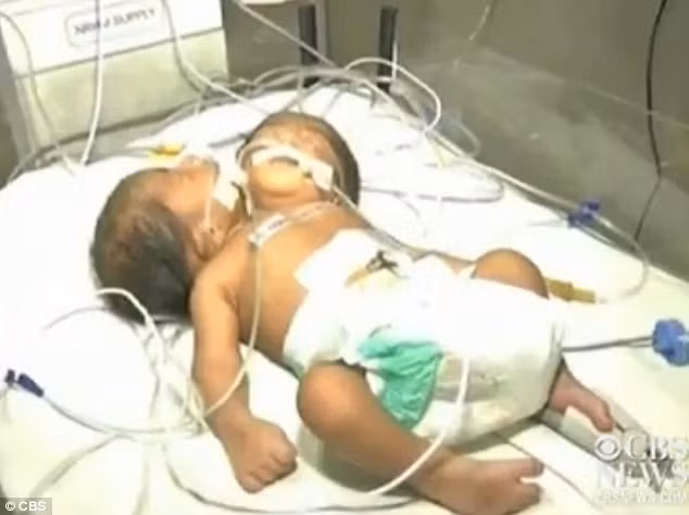 Cặp song sinh dính liên thân ở Ấn Độ.