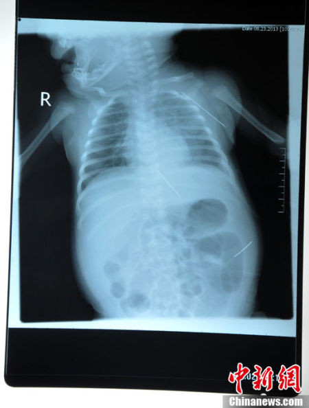 Ảnh chụp X-quang cho thấy vị trí của chiếc kim khâu.