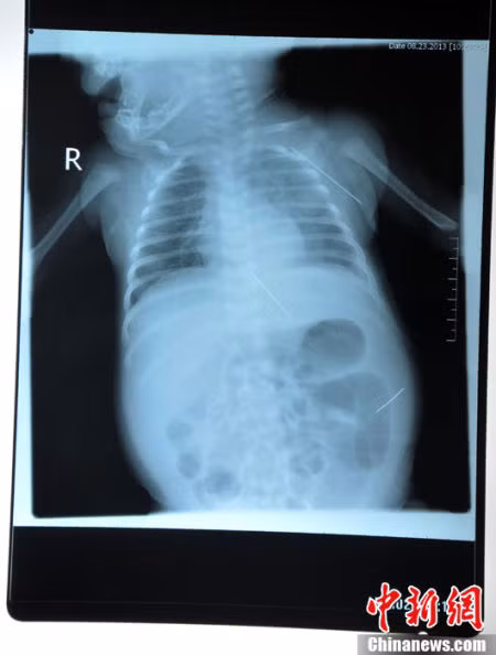 Ảnh chụp X-quang cho thấy vị trí của chiếc kim khâu.