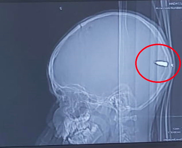 Thấy con hay buồn ngủ bố mẹ đưa đi chụp CT và phát hiện sốc ảnh 1