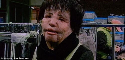 Đồng thời, nó sẽ khiến gương mặt của chúng ta bị “đơ” cứng, “mất cảm xúc”, thậm chí có thể bị sưng phồng. Nguy hiểm hơn, các bạn còn có thể gặp phải các biến chứng như các hóa chất bám chặt vào mô hoặc “di cư” trên mặt, khiến khuôn mặt chúng mình bị méo mó, biến dạng nghiêm trọng.