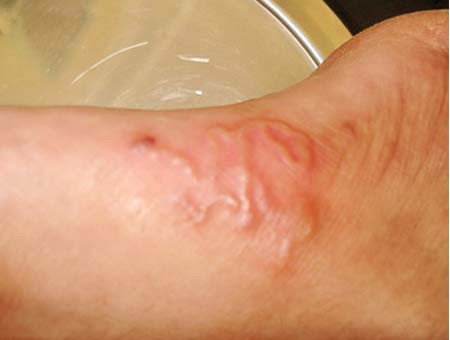 Bệnh nhân bị giun bò dưới da