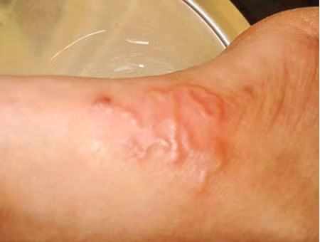 Bệnh nhân bị giun bò dưới da