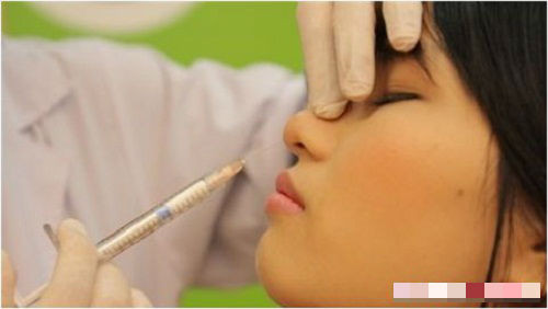 Hiện nay có rất nhiều cách để nâng mũi như bọc sụn, cấy mỡ mũi, tiêm filler… Tuy nhiên, dù với cách làm nào, chúng ta cũng có thể dễ dàng gặp phải những biến chứng trên gương mặt.