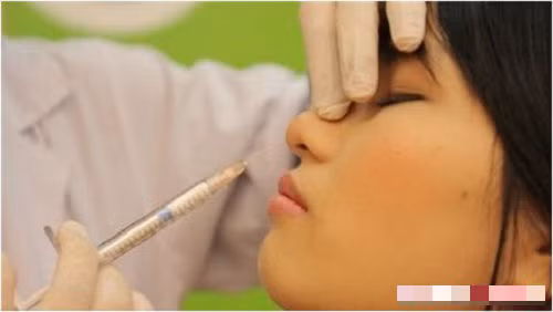 Hiện nay có rất nhiều cách để nâng mũi như bọc sụn, cấy mỡ mũi, tiêm filler… Tuy nhiên, dù với cách làm nào, chúng ta cũng có thể dễ dàng gặp phải những biến chứng trên gương mặt.