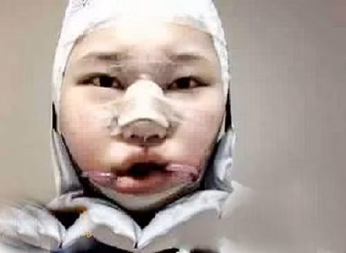 Khả năng cao nhất là khuôn mặt không cân xứng, bị “đơ”, “mất cảm xúc”, thậm chí còn có thể bị dị dạng, thiếu hụt xương… Bên cạnh đó, một số trường hợp còn phải hứng chịu thêm những “vị khách” mới trên gương mặt mình như các vết sẹo hay phần xương thừa, xương lệch ra…