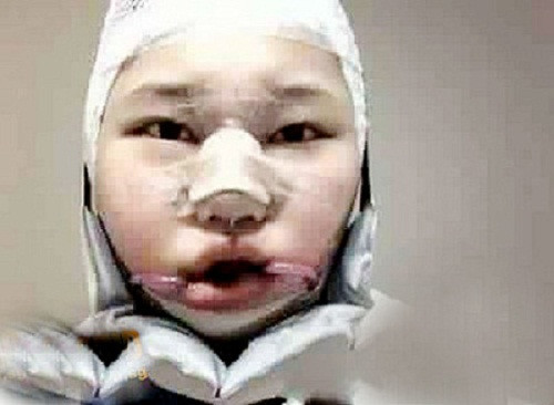 Khả năng cao nhất là khuôn mặt không cân xứng, bị “đơ”, “mất cảm xúc”, thậm chí còn có thể bị dị dạng, thiếu hụt xương… Bên cạnh đó, một số trường hợp còn phải hứng chịu thêm những “vị khách” mới trên gương mặt mình như các vết sẹo hay phần xương thừa, xương lệch ra…