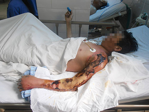 Bệnh nhân bị vi khuẩn "ăn thịt"