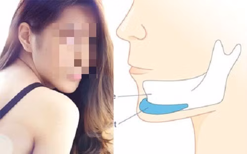 Độn cằm: Phẫu thuật độn cằm được biết đến là cách để có được một chiếc cằm nhọn, dài, thon gọn và hài hòa hơn. Độn cằm được thực hiện bằng cách rạch phần thịt ở dưới cằm và đưa phần độn vào lắp ráp bên trong. Nó có liên quan trực tiếp tới các phần quan trọng trên gương mặt, vì thế có thể dễ dàng xảy ra nguy hiểm.