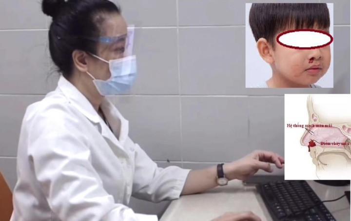 Tại sao trẻ hay bị chảy máu cam vào mùa đông? Tai sao tre hay bi chay mau cam vao mua dong?