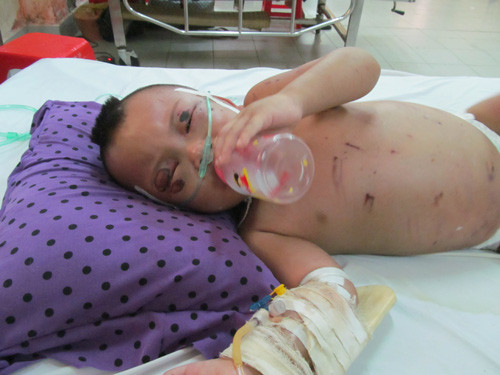 Bé K. đang được điều trị tại bệnh viện.