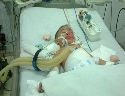 Bé Thiên Hòa tại BV Nhi đồng Đồng Nai.