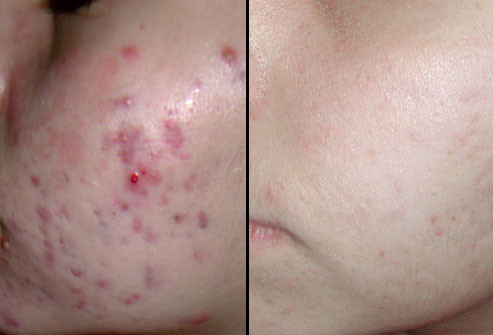 Trước và sau khi điều trị bằng Laser diode: Điều trị bằng Laser diode có thể cần vài lần mới đạt kết quả tối đa. Trong hình ảnh này, mụn trứng cá đã được cải thiện đáng kể trong 6 tháng sau loạt điều trị 5 lần bằng Laser diode.